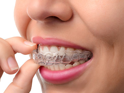 The image shows a person wearing clear aligners, which are part of an orthodontic treatment system, with their hand gently touching the lower front teeth.