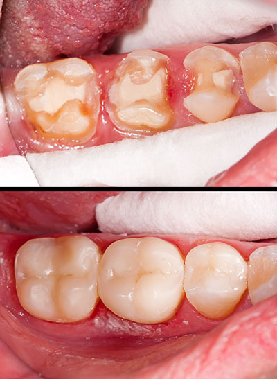 The image is a composite of two photographs, showing a close-up view of a person s mouth with yellowed teeth and gum disease, followed by an extreme close-up of the same mouth after dental treatment, revealing clean, white teeth.