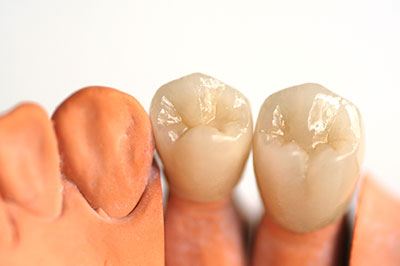 A composite dental implant with a crown and a bridge, showcasing the tooth replacement process.