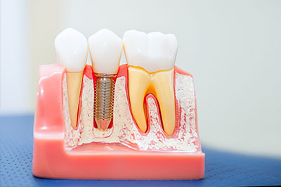 The image shows a model of human teeth with dental implants, featuring a close-up view of the implantation process.