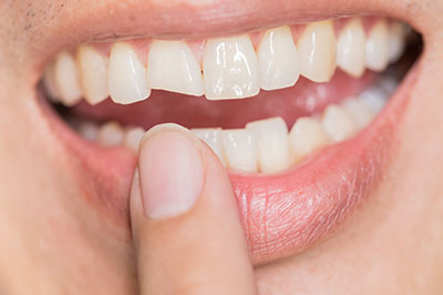 The image shows a close-up of a person s mouth with teeth, holding a finger near the lower lip, and there is a focus on the teeth, which appear to be straight and well-maintained.