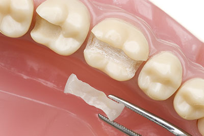 The image shows a close-up of a dental implant being inserted into a tooth socket, with a small amount of bone grafting material visible.