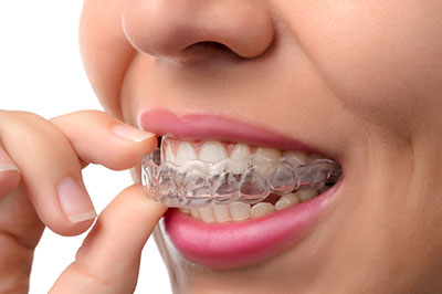 A person with a smile showing their teeth, which are fitted with a clear aligner.