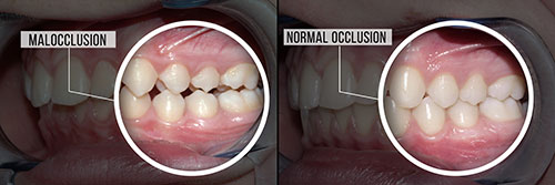 The image shows a side-by-side comparison of two sets of teeth, one with normal occlusion and the other with malocclusion.