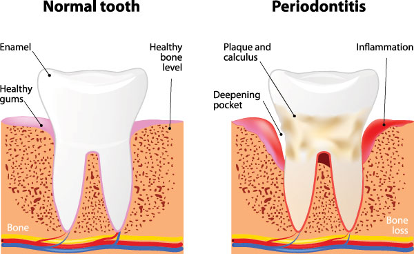 The image is a medical illustration showing the stages of tooth decay from normal to severe, with labels indicating the progression of cavities and gum disease.