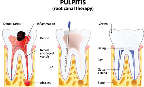 The image is a medical illustration showing the anatomy of a tooth with pulpitis, highlighting the affected areas and structures within the tooth s root canal therapy.