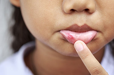 A young child with a pimple on their face, pointing to it with their finger.