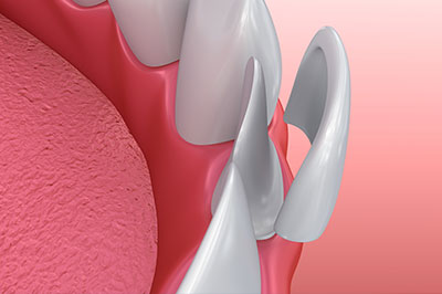 The image shows a close-up of a dental implant with multiple spikes, set against a red background that resembles a tongue or a gum surface.