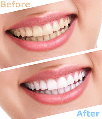 The image displays a before-and-after comparison of teeth whitening, with the  before  showing yellowed teeth and the  after  showing bright white teeth.