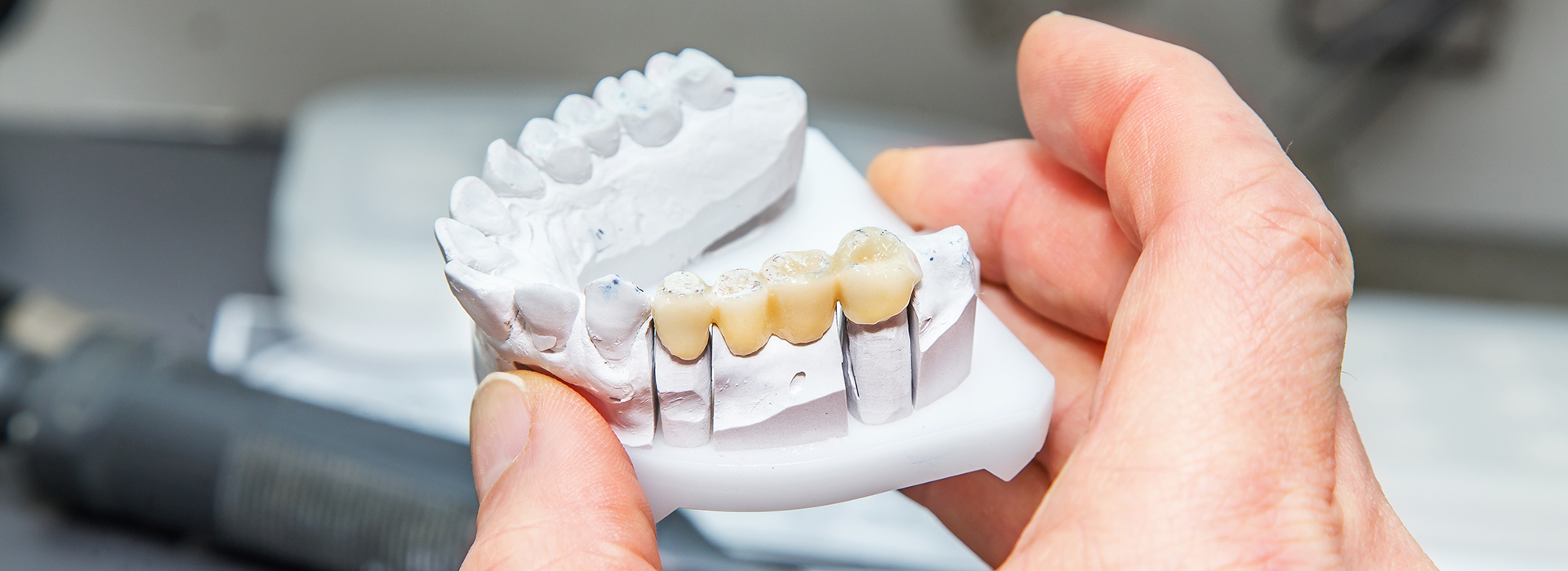 The image shows a person holding a 3D printed model of a dental implant, with the focus on the implant s design and structure.