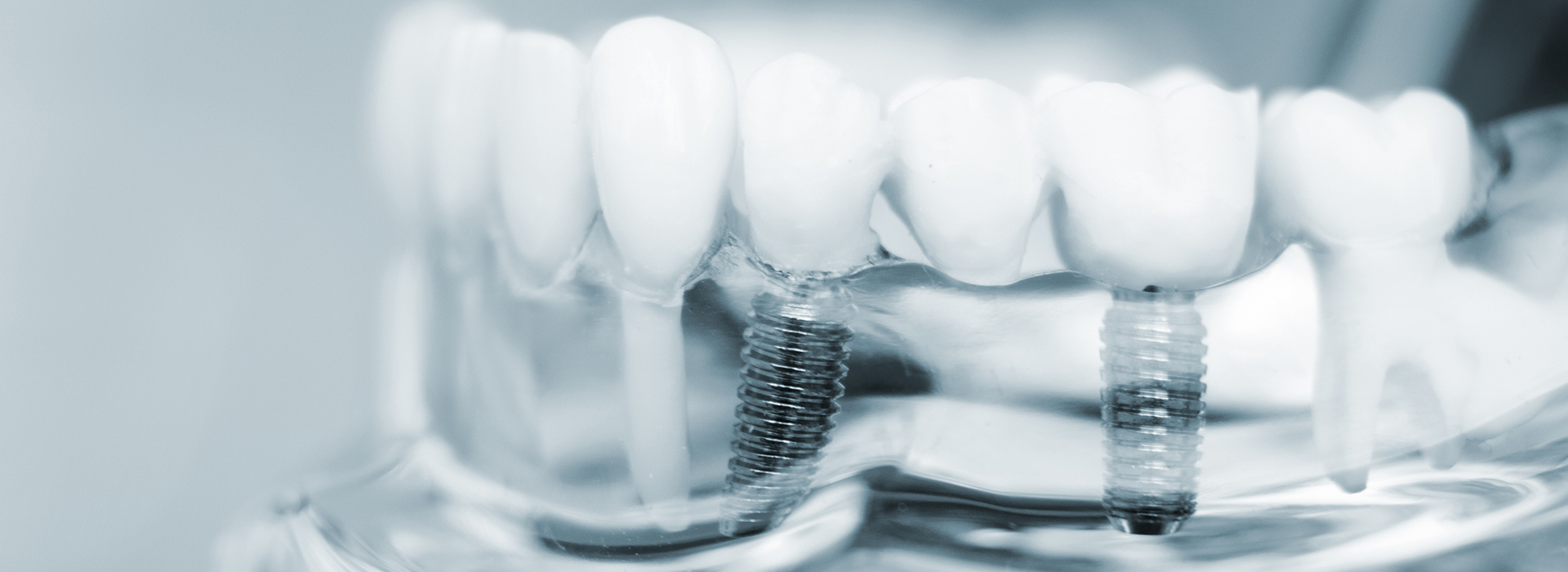 An image of a close-up view of a dental implant with screws and abutments, showcasing the structure of a tooth replacement system.