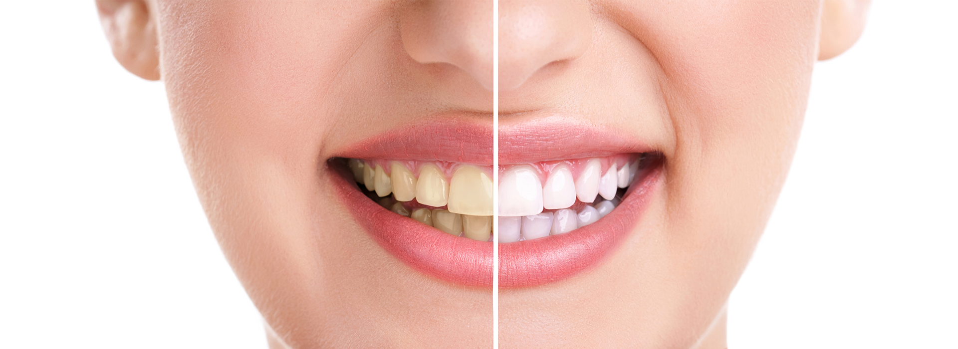 The image features a close-up of a person s face with a focus on teeth whitening, showing before and after results.