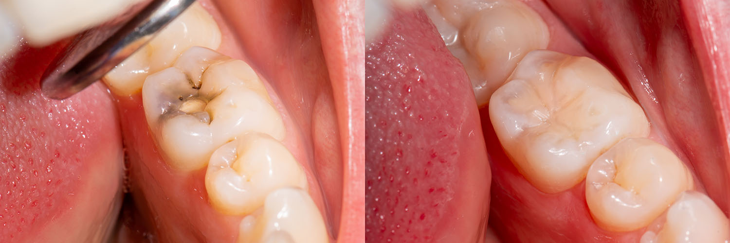 The image shows a close-up view of a mouth with multiple teeth showing signs of decay and damage, with a focus on the lower front teeth area, featuring a dental implant and surrounding inflammation, possibly indicating an infection or gum disease.