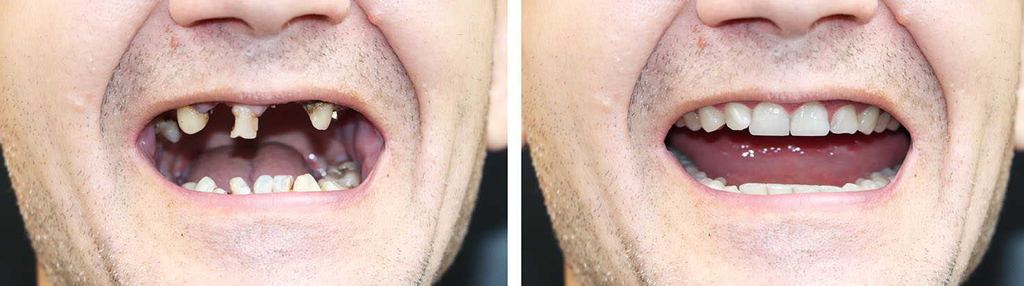 The image shows a person with multiple teeth missing, captured from different angles, creating an illusion of a smiling face with open mouths.