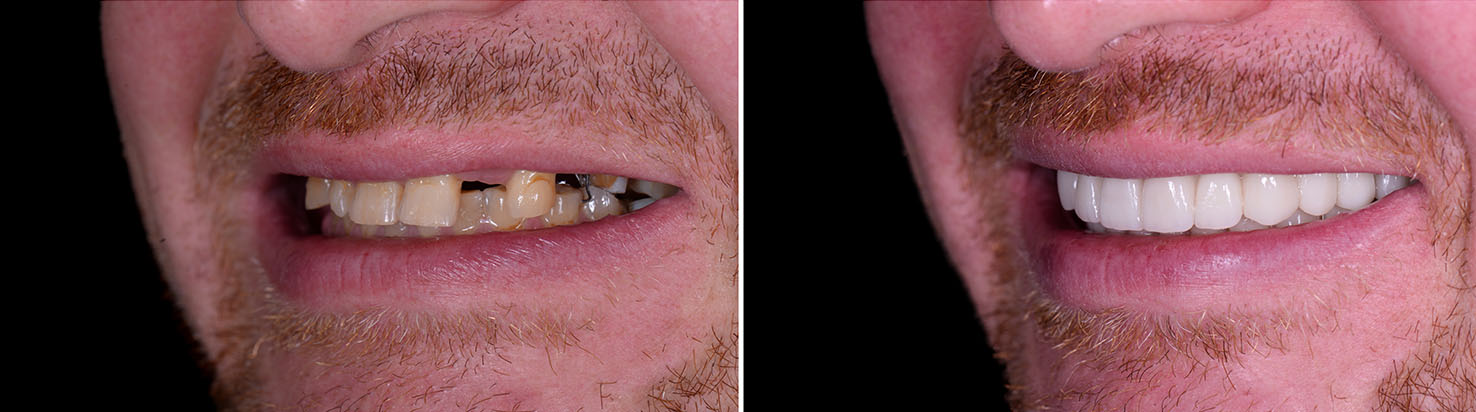 The image shows a person s smiling face with a noticeable smile, displaying both natural teeth and dental implants, presented side by side in a split-screen format.