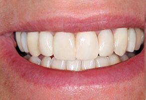 The image shows a close-up of a person s smiling mouth with straight, white teeth.