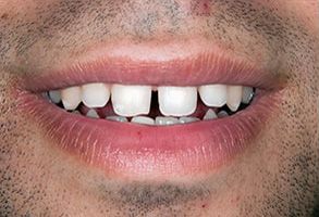 This is a close-up image of a person s mouth with teeth, showcasing the dental implant and gum line.